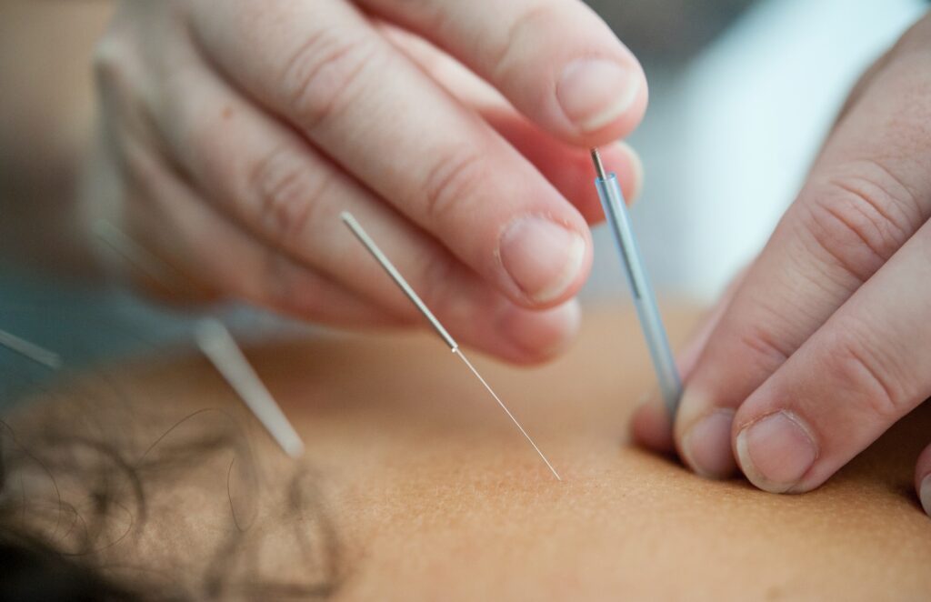Akupunktur nåle kan placeres med et rør for øget præcision